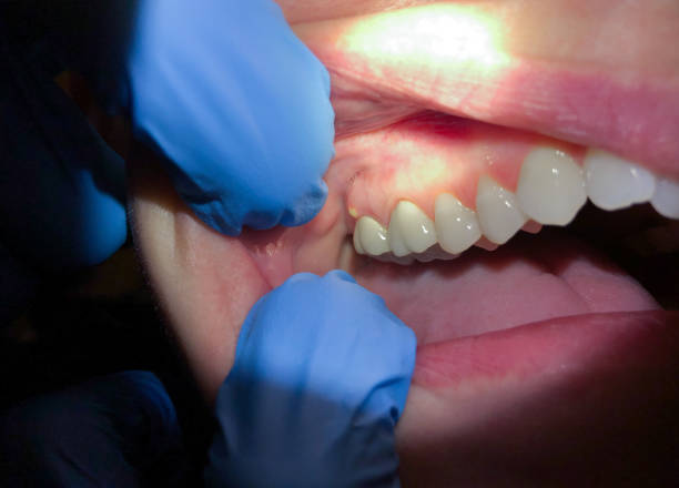 Best Emergency Treatment for Dental Infections or Abscesses in Floral Park, NY